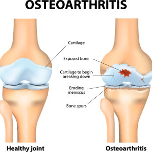 Non-Surgical Treatment for Osteoarthritis Shoreview, MN